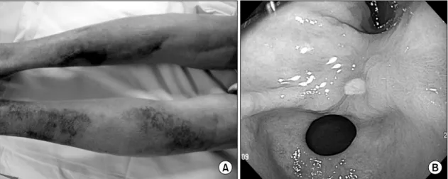 Fig. 1. (A)  Multiple  petechiae  and  ecchymosis  on  both  lower  extremities  and  marked  swelling  of  the  left  leg  compared  to  the  right  leg
