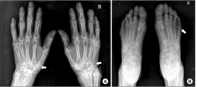Fig. 3. Whole-body  bone  scan  demonstrating  increased  uptake  into  multiple  joints  of  both  hands,  both  wrists,  left  elbow,  right  ankle,  the  medial  aspect  of  the  left  knee  joint,  and  both  hip  joints.