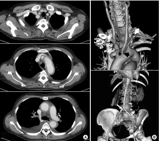 Fig. 1. Initial  axial  views  of  computed  tomographic  angiography  revealed  a  thickened  vascular  wall  with  delayed  enhancement  in  the  right  carotid  artery,  aortic  arch,  and  descending  aorta  (A)