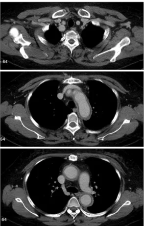 Fig. 3. Computed  tomographic  angiography  taken  after  21  months  still  revealed  active  aortitis.