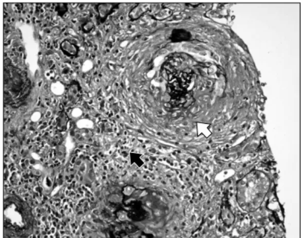 Fig. 1. The  glomerulus  reveals  a  crescent  formation  (white  arrow).  The  mesangium  is  expanded  due  to  an  increase  of  matrix  with  segmental  hypercellularity  and  focal  neutrophilic  infiltration