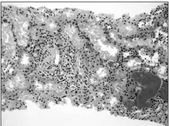 Fig. 2. The  glomerular  basement  membranes  are  thickened  with  subendothelial  immune  complex  deposits