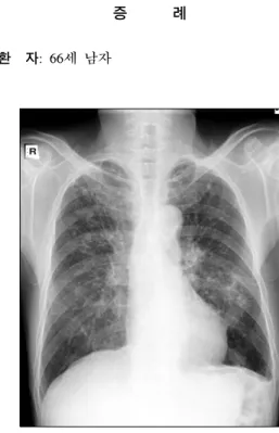 Fig. 1. Chest  radiography  shows  bilateral  patchy  conso- conso-lidation  and  increased  interstitial  marking  of  left  lower  lung  field  with  bihilar  nodular  lesion.