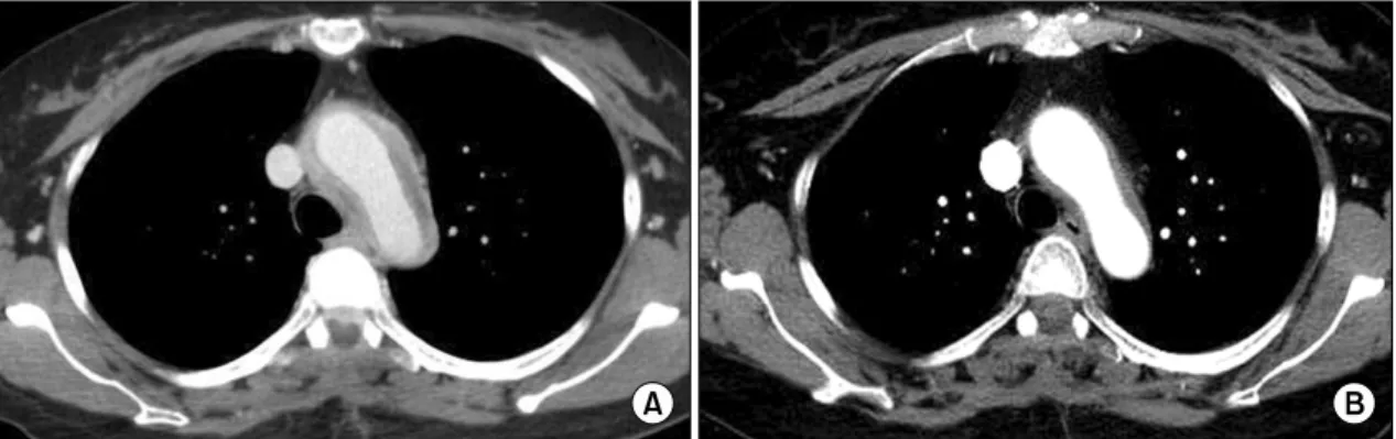 Fig. 2. A  chest  computed  tomography  scan  showed  localized  wall  enhancement  with  peripheral  onion-shaped  density  at  the  aortic  arch  level  (A)