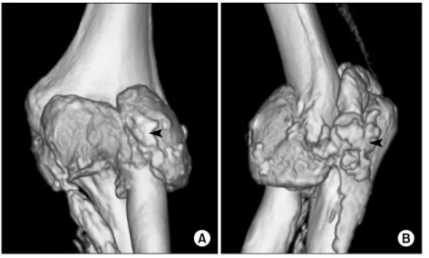 Fig. 2. Computed  tomography  scan  showing  nodular  calcified  deposit  in  the  distal  humerus  and   pro-ximal  ulnar  and  radius  (arrow).16이었으며 소변검사에서  특이사항이 없었다