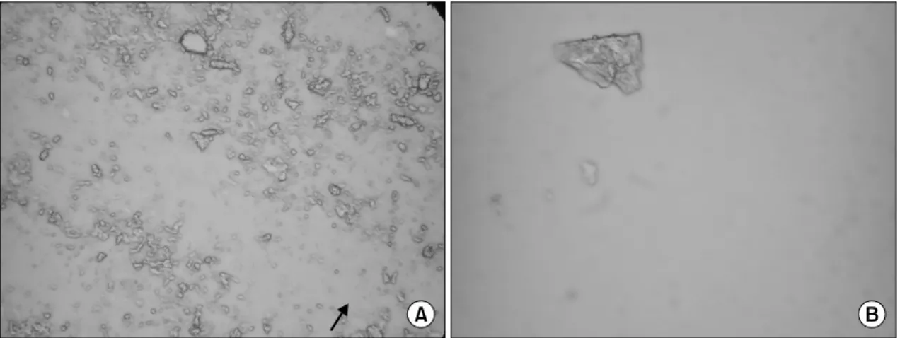 Fig. 3. Examination  of  synovial  fluid  under  polarized  microscopy  shows  rhomboid  crystals  with  weakly  positive  birefringence  (wet  smear,  compensator  axis:  ↗,  A,  ×400,  B,  ×1,000).