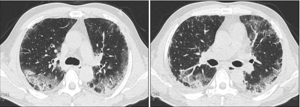 Fig. 4. Repeated  (10  days  later)  high  resolution  computed  tomography  scan  showed  an  increase  in  the  ground  glass  opacity,  aggravation  of  the  fibrotic  changes,  and  bronchial  wall  thickening.