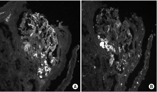 Fig.  3.  Direct  immunofluorescence  microscopy  demonstrates  positive  mesangial  staining  for  IgA  (A)  and  C3  (B)  (×400)