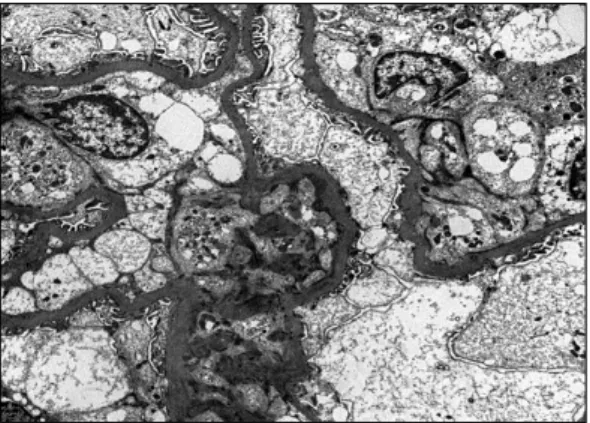 Fig. 4. The  electron  micrograph  demonstrates  electron  dense  deposits  in  the  mesangial  and  paramesangial  areas  (×6,000).
