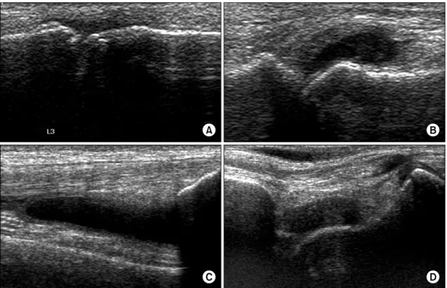 Fig. 1. Ultrasonographic  findings  of  joint  effusion.  (A)  Metacarpophalangeal  joint,  (B)  metatarsophalangeal  joint,  (C)  suprapatellar  recess  of  the  knee  and  (D)  anterior  talotibial  joint.