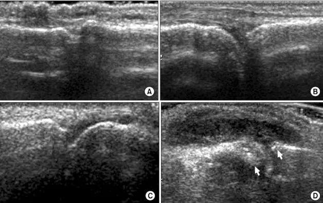 Fig. 2. Ultrasonographic  findings  of  joint  effusion  can  be  graded  according  to  the  amount