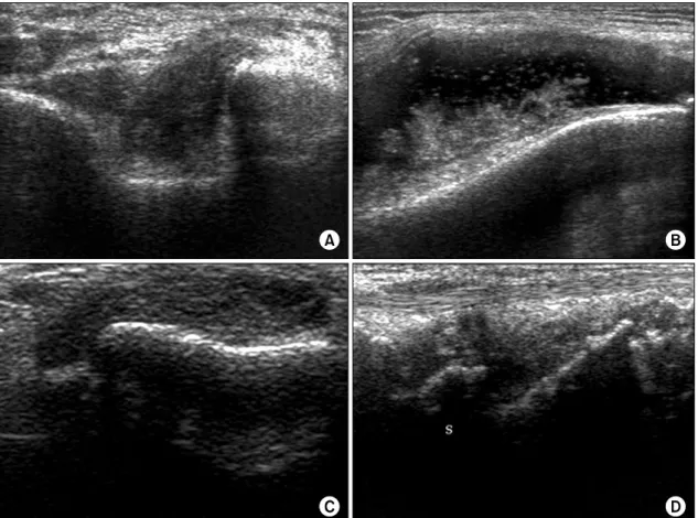 Fig. 3. Ultrasonographic  findings  of  synovial  proliferation.  (A)  Olecrenon  fossa  of  the  elbow,  (B)  lateral  recess  of  the  knee,  (C)  metacarpophalangeal  joint,  and  (D)  dorsal  carpal  joint.