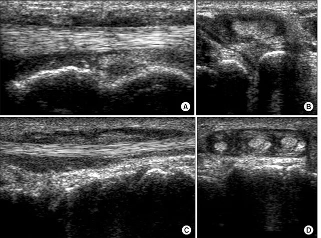 Fig. 5. Ultrasonographic  findings  of  tenosynovitis.  (A,  B)  Anechoic  fluid  accumulation  in  the  sheath  of  posterior  tibial  tendon  (longitudinal  and  transverse  scans)