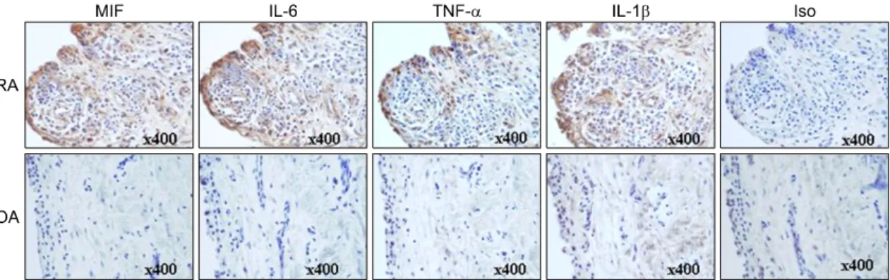 Fig. 1. Increased  expression  of  MIF,  IL-6,  TNFα and  IL-1β in  RA  synovium.  Immunostaining  was  performed  using  the  specific  antibodies  against  MIF,  IL-6,  TNFα and  IL-1β in  synovial  biopsy  samples  from  patients  with  rheumatoid  arth