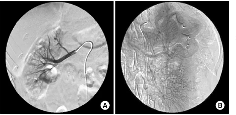 Fig. 3. Angiography. Renal  angiography  showing  a  multiple   microa-neurysm  in  the  renal  artery  branches  (A)