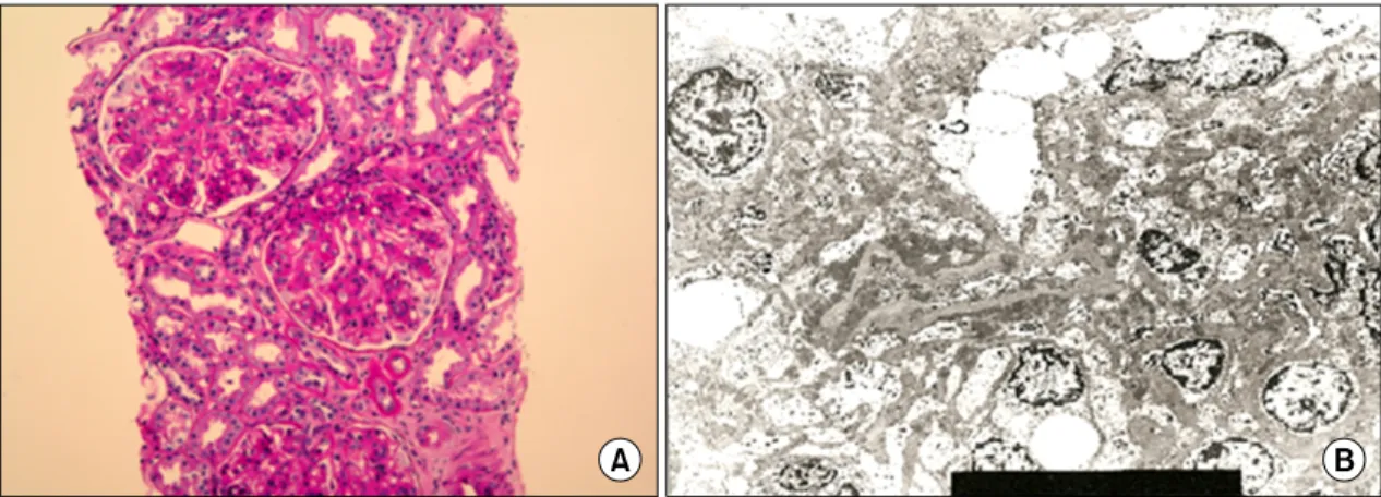 Fig. 2. 27-year-old  woman  with  lupus  nephritis  WHO  class  III+V.  (A)  Light  microscopy  shows  moderate  hypercellular  mesangial  tissue  and  focal  endocapillary  proliferation