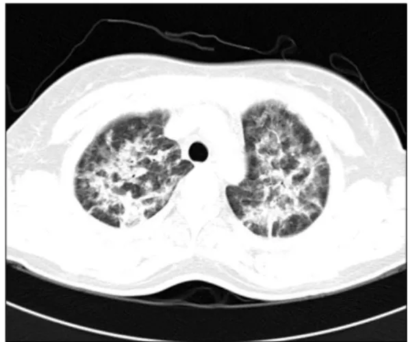 Fig. 2. The  HRCT  shows  consolidations  and  ground  glass  opacities  in  both  lung  fields,  and  this  it  appears  with  a  sparing  patterns  at  the  subpleural  regions.