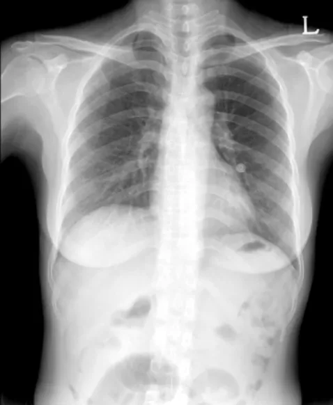 Fig. 3. After  4  days  treatment  with  TMP-SMX,  the  X-ray  shows  markedly  improved  findings.