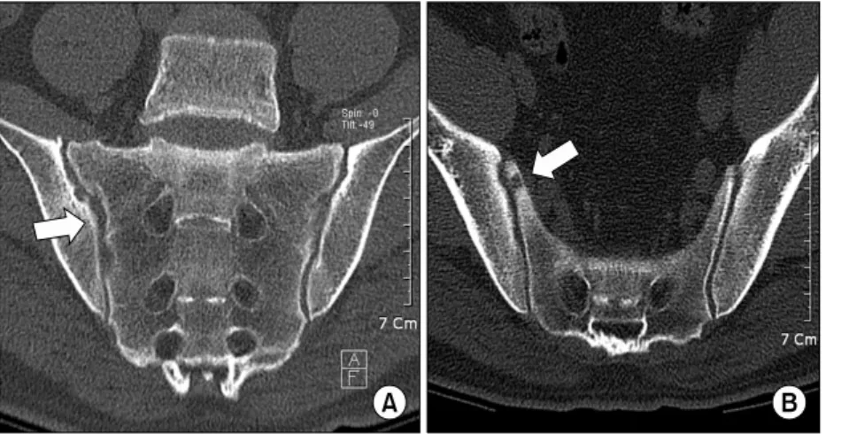 Fig. 4. The  coronal  reformatted  CT  image  of  the  SI  joints  show  multiple,  well-marginated  ero-sions  along  the   arti-cular  surfaces  of  the  right  SI  joint  (A,  B).