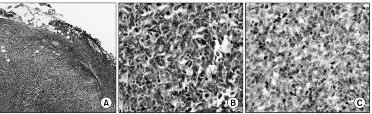 Fig. 1. Cervical  lymph  node  biopsy.  (A)  Extensive  replacement  of  normal  architecture  by  neoplastic  centrocytes  and  centroblasts  (H&amp;E  stain,  ×100),  (B)  Centroblastic  lymphoma  shows  neoplastic  cells  that  are  much  larger  than  