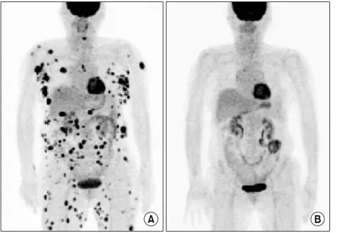 Fig. 2. Positron  emission  to- to-mography.  (A) Probably  multiple  malignant   le-sions  on  subcutaneous  nodules, abdominal  lymph  nodes  (LNs),  both  axillary  LNs  and  inguinal  LNs  and  bone  involvements  on  T5  and  C5  were  shown