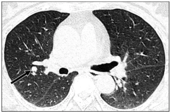 Fig. 1. Lung  setting  computed  tomography  (CT)  scan  of  the  chest  reveals  a  well  defined  nodule  in  the  right  upper  lobe  (0.7  cm  in  size,  arrow).