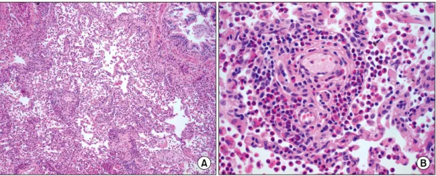Fig. 3. Localized  eosinophilic  pneumonia  (H&amp;E,  ×100,  A)  with  perivascular  eosinophilic  infiltration  in  lung  tissue  (H&amp;E, 