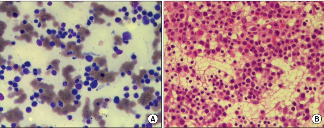 Fig. 2. Bone  marrow  aspiration  smear  (Wright-Giemsa  stain,  ×400)  (A)  &amp;  biopsy  (H-E  stain,  ×400)  (B)  Revealed  hypercellularity  with  normoblastic  hyperplasia.