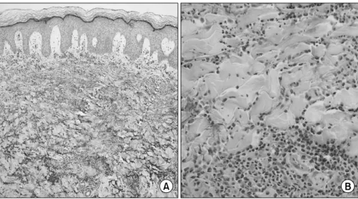 Fig.  3.  Among  dermal  collagen  bundles,  there  are  col- col-lections  of  eosinophils  with  eosinophilic  granules,  so  called  "flame  figures"  (H&amp;E,  ×400).