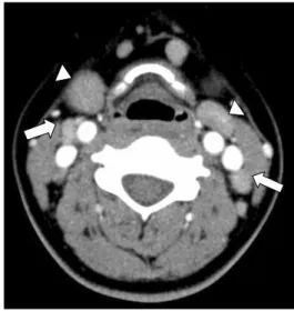 Fig.  1.  Neck  computed  tomography  scan  shows  mild  hyperplasia  of  lingular  tonsils  (arrow  head)  and  multiple  lymphadenopathies  (arrow)  bilaterally.