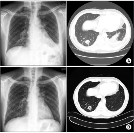 Fig.  1.  Chest  PA  and  Chest  CT  on  admission  (A)  and  2  months  later  (B)  show  2.8  cm  sized,  spiculated  GGO  nodule  with  air-bronchogram  in  lateral  basal  segment  of  RLL