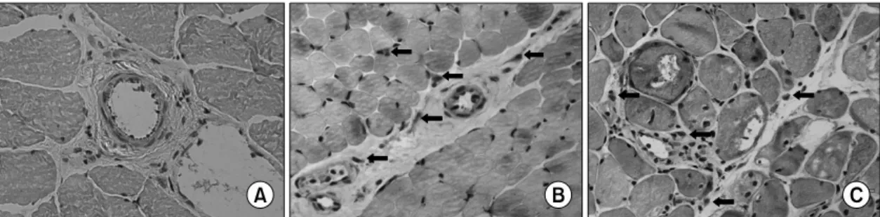 Fig.  1.  Immunohistochemistry  of  IL-17  in  muscle  tissues  from  patients  with  IIMs  (B,  C)  and  control  (A)