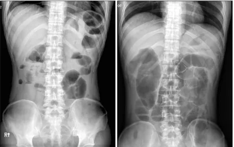 Fig. 1. Simple  abdomen  erect  and  supine  views  show  severe  small  bowel  dilatation,  suggesting  small  bowel  obstruction.