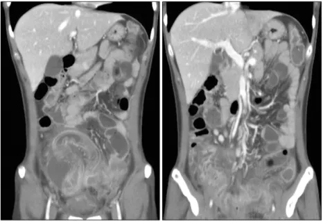 Fig.  2.  Abdominal  CT.  The  terminal  ileum  shows  diffuse  wall  thickening.  It  reveals  the  lower  abdominal  peritonitis  and  extraluminal  fluid  collection  around  the  terminal  ileum.