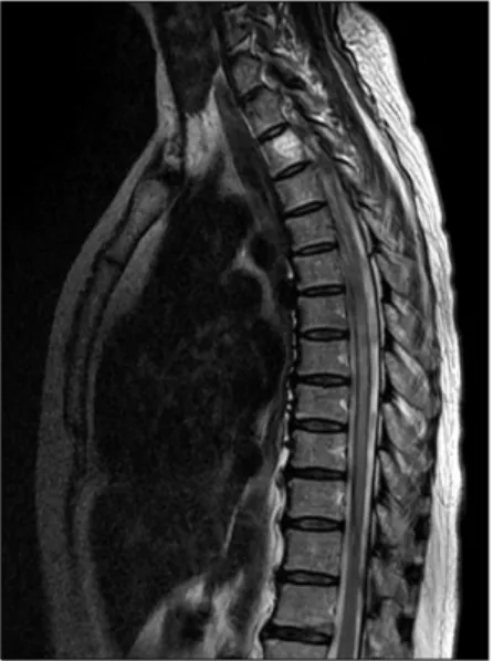 Fig.  1. Diffuse  high  signal  intensities  are  seen  in  the  spinal  cord  from  C6  to  T11  on  T2  weighted  image  without  enhancement  after  infusion  of  the  contrast  media,  mainly  central  gray  matter  involvement  when  she  was  first  