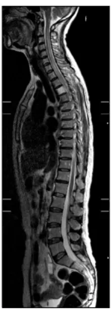 Fig.  2. Diffuse  high  signal  intensities  are  seen  in  the  spinal  cord  with  intramedullary  high  signal  intensity  change  in  the  cervical  and  upper  thoracic  levels  (C2  to  T9  levels).