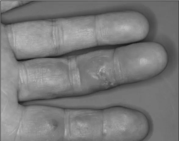 Fig.  1.  0.5∼1  cm  sized  skin-colored  4  nodules  on  palmar  surface  of  fingers.서      론    Etanercept은  종양괴사인자  알파(TNF-α)에  수용체와  경쟁적으로  결합하는  수용성  단백으로  TNF-α 억제제  역할을  하여  류마티스관절염  치료에  탁월한 효과를  가져왔다  (1)