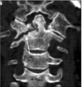 Fig. 1. Unilateral  facet  arthritis  of  atlanto-axial  joint  in  RA  patient.