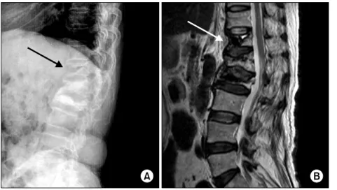 Fig. 5. Multiple  osteoporotic  compression  fracture.