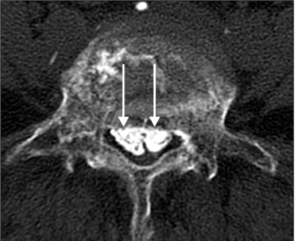 Fig. 8. Severe  canal  stenosis  due  to  cement  leakage  after  vertebroplasty.