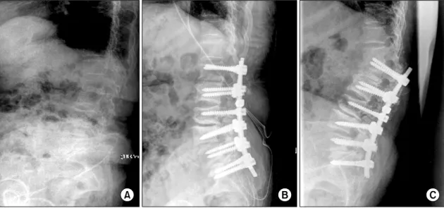 Fig. 12.  Anterior  fusion  for  osteoporotic  burst  fracture  in  RA  patient.  (A)  preoperation,  (B)  MRI,  (C)  postoperation.