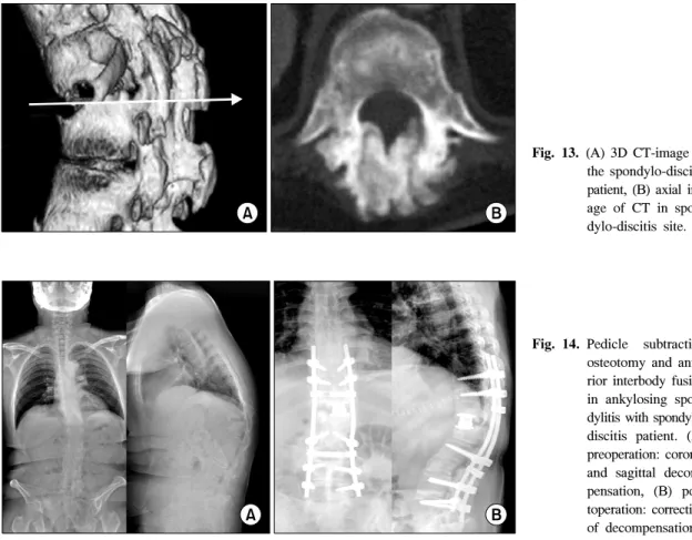 Fig. 13. (A)  3D  CT-image  of  the  spondylo-discitis  patient,  (B)  axial   im-age  of  CT  in   spon-dylo-discitis  site.