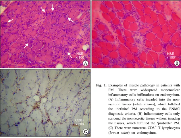 Fig. 1. Examples  of  muscle  pathology  in  patients  with  PM.  There  were  widespread  mononuclear  inflammatory  cells  infiltrations  on  endomysium