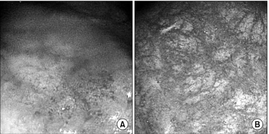 Fig. 1. Colonoscopic  findings. 