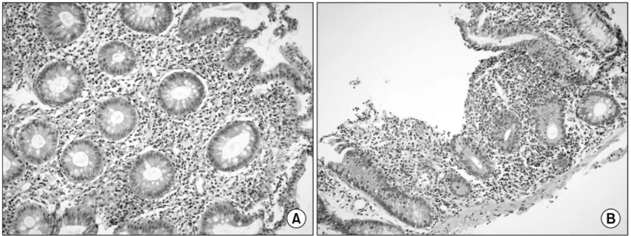 Fig. 2. Microscopic  finding.  The  rectal  mucosa  shows  heavy  inflammatory  infiltration  in  the  lamina  propria  (A)  and  aphtous  ulcer  (B)  with  severe  goblet  cell  depletion  (H&amp;E  stain,  ×200)