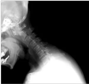 Fig. 1. Cervical spine lateral flexion view. Subluxation of the first cervical vertebra on the odontoid