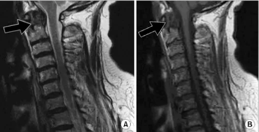Fig. 3. Hand AP x-ray shows soft tissue swelling on 2nd, 3rd and 4th PIP joints. Mild osteoporosis is also