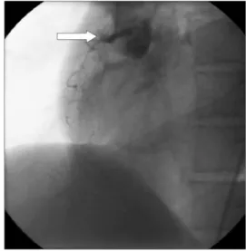 Fig. 1. Right coronary artery was obstructed similar to 4-year ago.