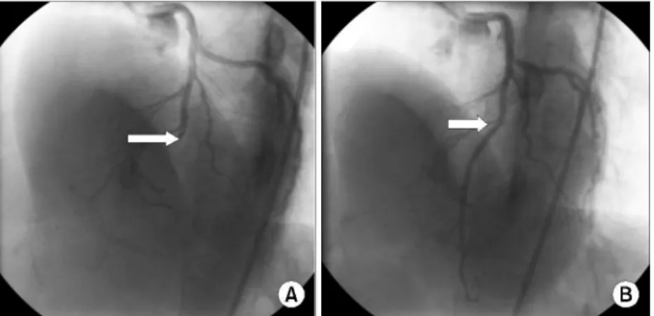 Fig. 3. Longitudinal filling defect was noted in portal phase coronal scan of abdominal CT, suggesting  intra-luminal thrombosis of intrahepatic inferior vena cava.