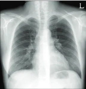 Fig.  1.  Chest  PA  shows  enlarged  central  pulmonary  arteries.(1).  폐동맥  고혈압은  전신성  류마티스  질환의  합병증  중  하나로  오른쪽  심장의  과부하와  운동능력  저하,  호흡곤란,  부정맥  등을  야기함으로써  사망의  주요한  원인이  되며  최근  그  중요성이  부각되고  있다